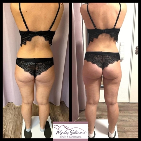 Abnehmen im Liegen Erfahrung Erfahrungsberichte Cellulite Behandlung Großbottwar Ludwigsburg Heilbronn Backnang Fett abnehmen