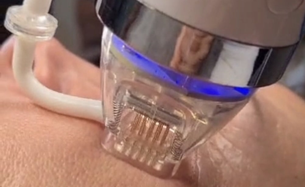 Eine Frau liegt entspannt auf einer Behandlungsliege, während ein Radiofrequenz-Microneedling-Gerät sanft auf ihre Wange aufgesetzt wird. Die Kosmetikerin führt die Behandlung in gleichmäßigen, systematischen Schritten durch. Im Fokus stehen das ruhige Gesicht der Kundin und das präzise Arbeiten des Geräts, das winzige Mikrokanäle erzeugt und dabei gleichzeitig Wärme abgibt.