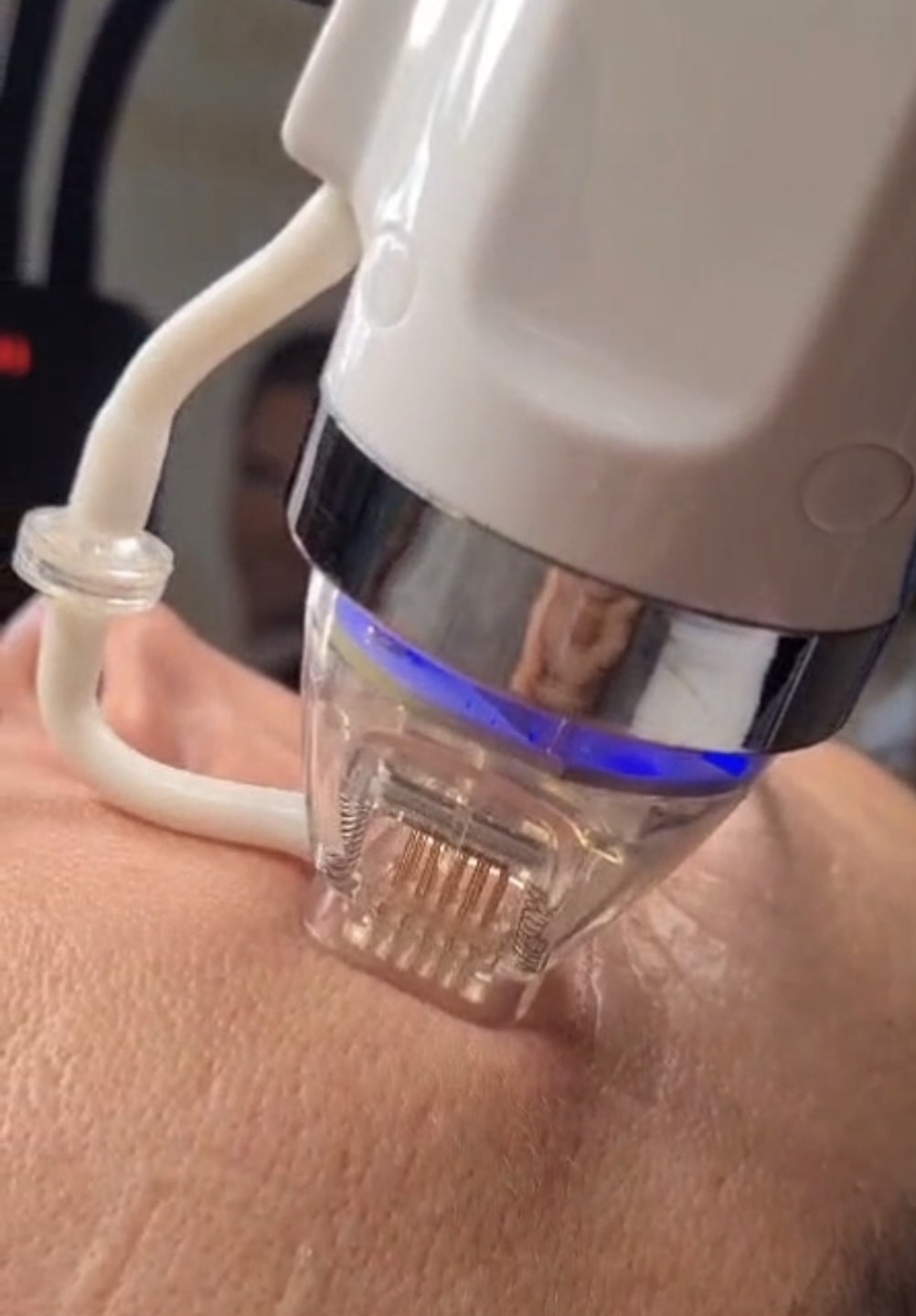 Das Gesicht einer jungen Frau während einer professionellen Radiofrequenz-Microneedling-Behandlung. Das spezielle Handstück des Geräts wird kontrolliert und gleichmäßig über die Haut geführt. Die Kundin wirkt entspannt, während die Haut gezielt stimuliert wird, um die natürliche Regeneration und Kollagenbildung anzuregen.