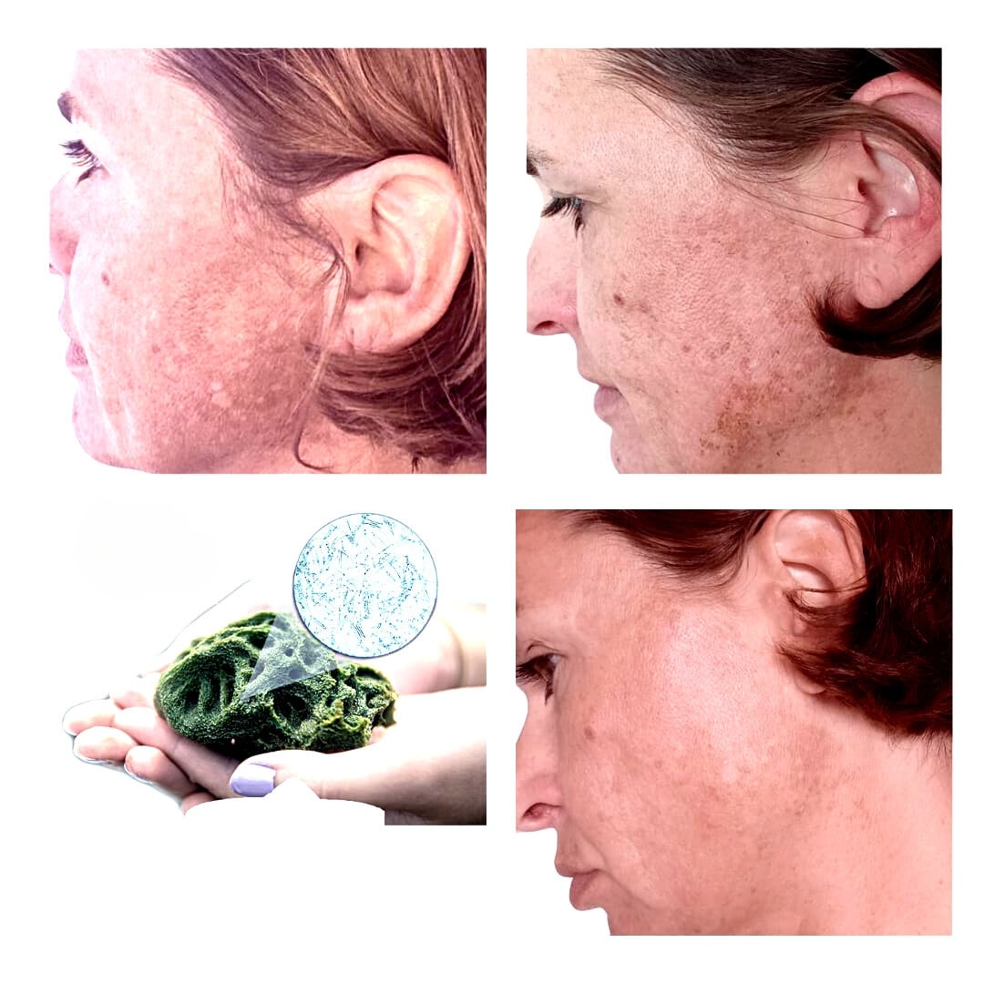 SQT Bio-Microneedling Behandlung in Mirela's Schönerie: 100% natürliche Hautverjüngung ohne Chemie. Ideal gegen Akne, Aknenarben, Pigmentstörungen, große Poren, fettige Haut und Falten für strahlendes Hautbild und Bio-Glow.